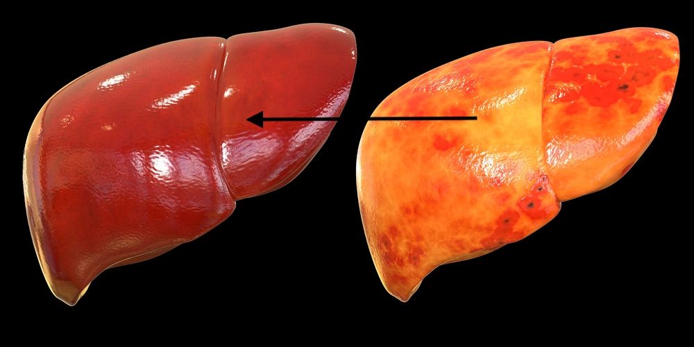 fatty-liver-disease-nafld-masld-can-be-reversed